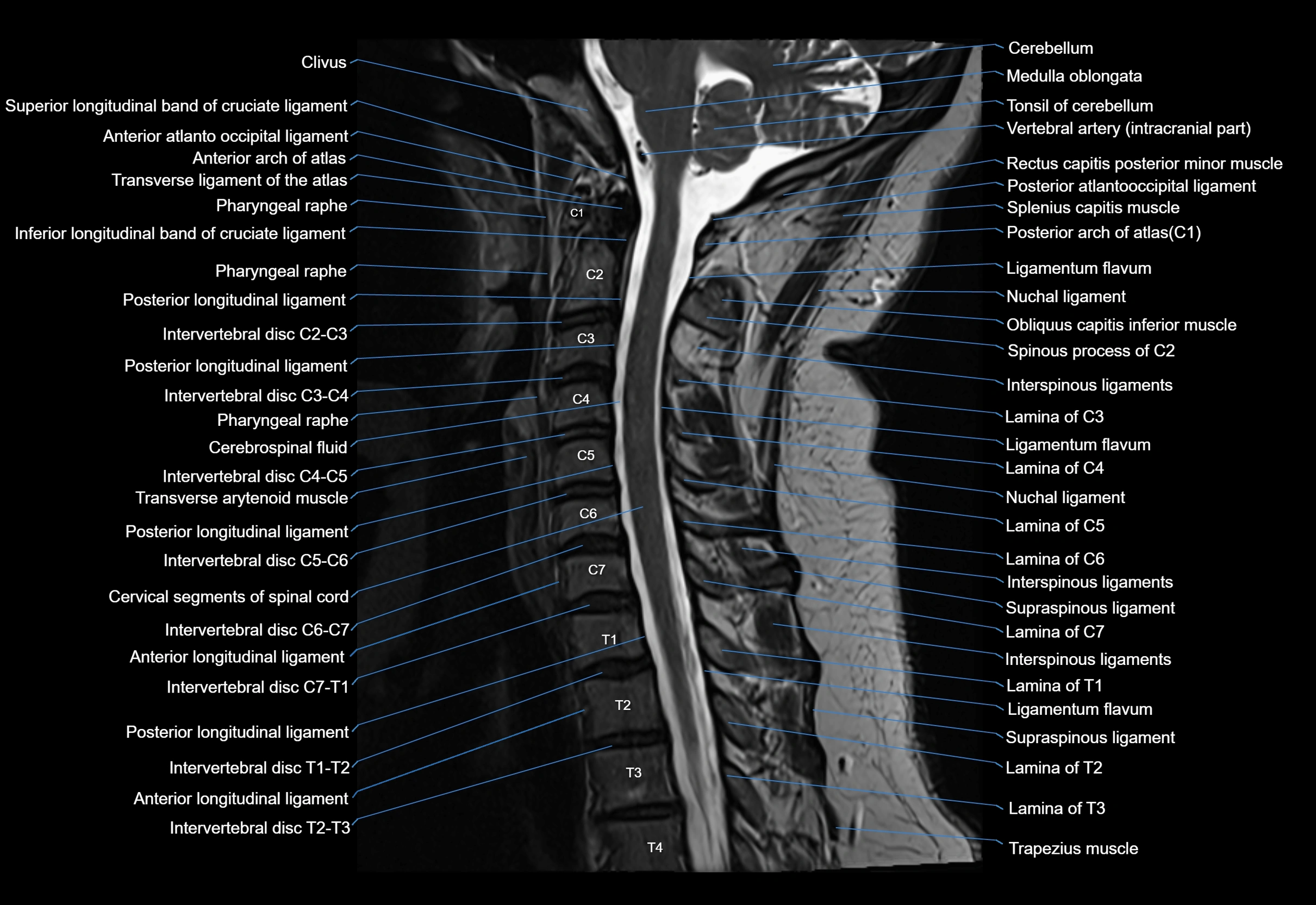 cervical spine cross sectional MRI anatomy 3T MRI  sagittal image-img-00001-00015.webp